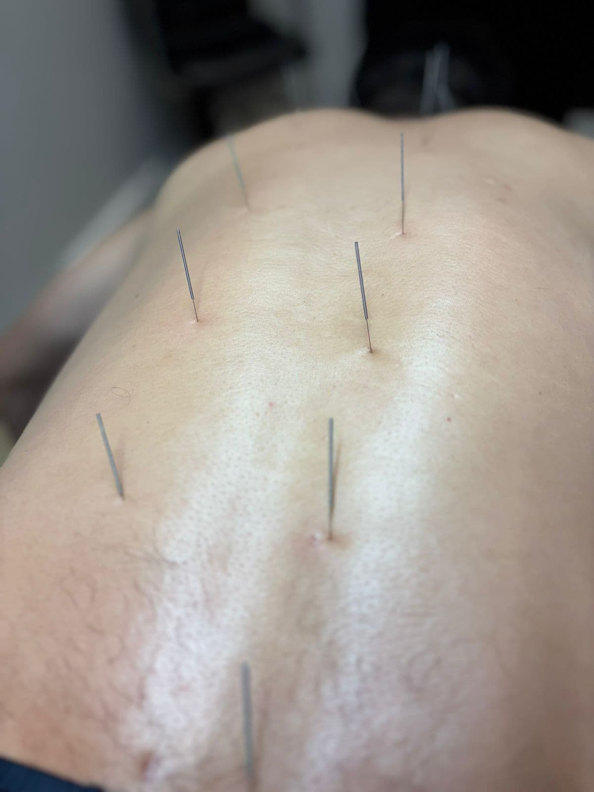 Dry Needling